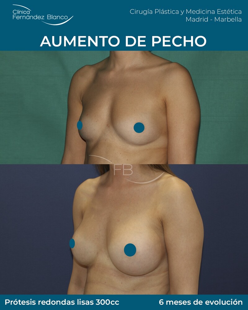 Before and After Result